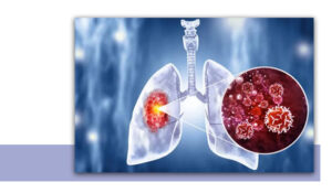 Lung Cancer