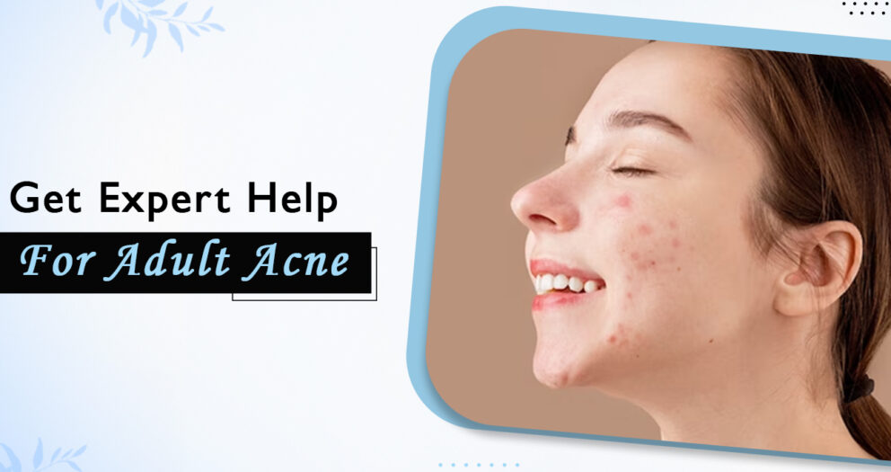 Adult Acne