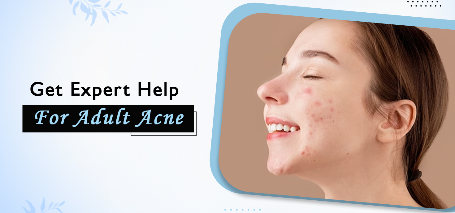 Adult Acne